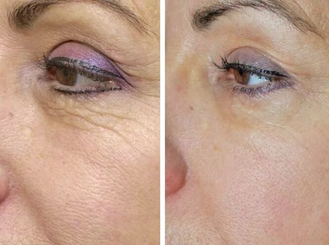 Eremuko laser aurretik eta ondoren